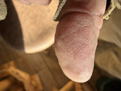 Thumb blister from the safety lever